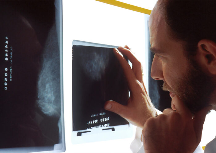 Medzi choroby kostí nepatrí len osteoporóza - čo ak máte osteomyelitídu?